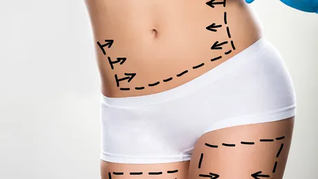 Abdominoplastia şi sarcina: 6 mituri demontate de specialist