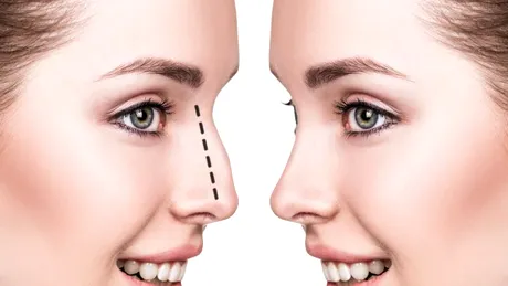 Rinoplastie: în ce constă procedura, recomandări pre şi postoperatorii, avantaje şi riscuri