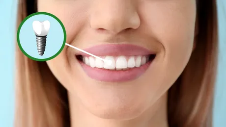 Implantul dentar – mituri despre durere, complicaţii şi preţuri