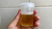 Urină urât mirositoare: Lista bolilor pe care le indică